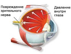 глаукома симптомы и лечение